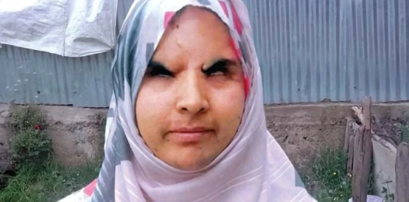 ১৪ বছর বয়সে পেলেট গানের ছররায় দৃষ্টিহীন কাশ্মীরের যুবতী